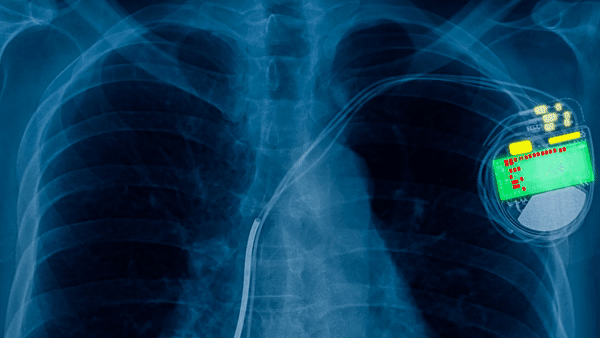 pacemaker